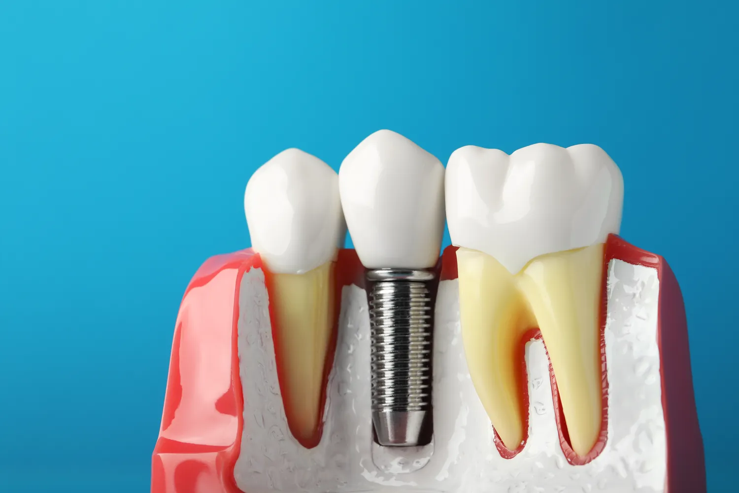 Implanty dentystyczne - czy mogą zastąpić prawdziwe zęby?