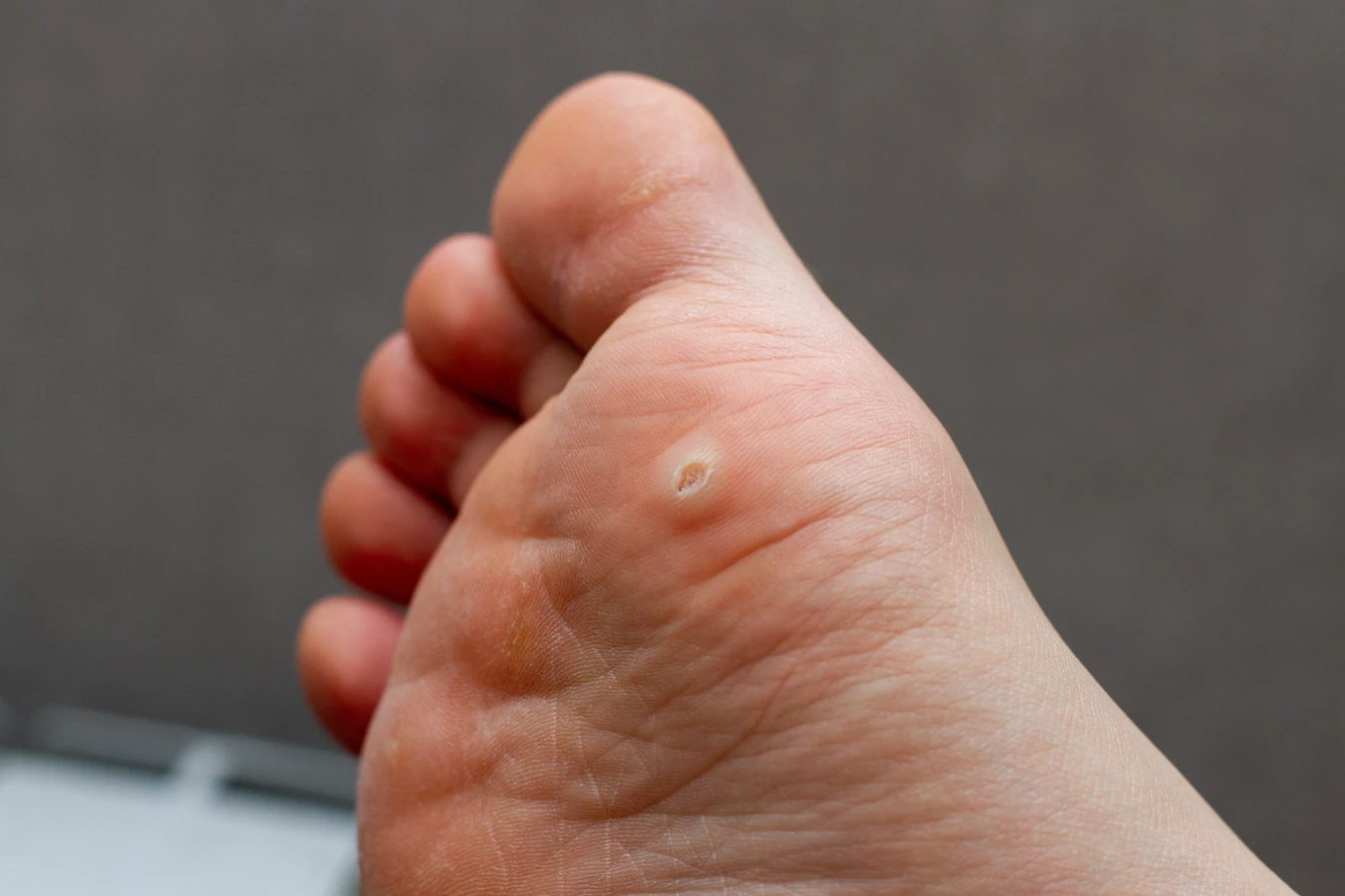 Pedicure leczniczy - czym jest i co warto wiedzieć na jego temat?