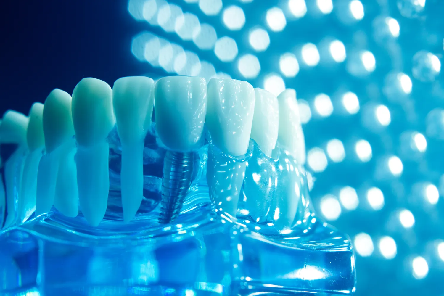 Licówki porcelanowe ranking Szczecin