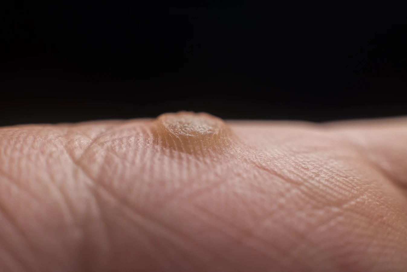 Od czego się robią kurzajki